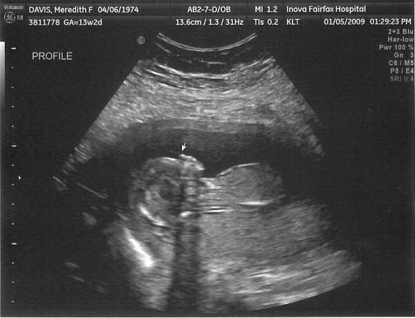 15.hafta-gebelik-ultrason