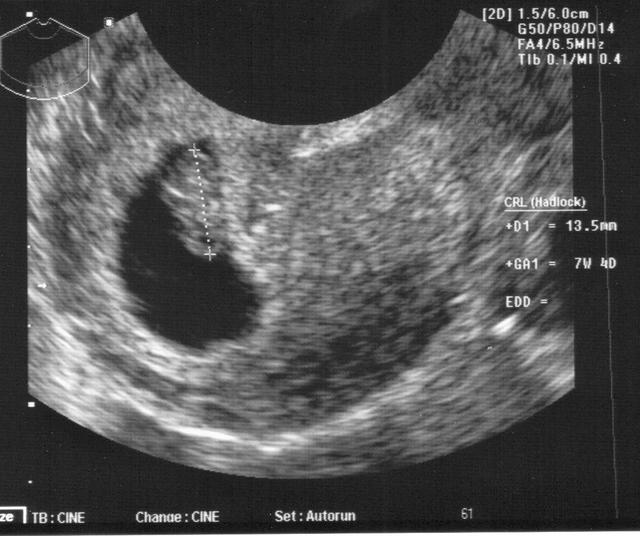 7-haftalik-ultrason