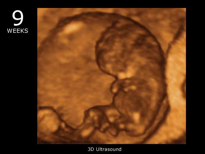 9 haftalik-ultrason-goruntusu